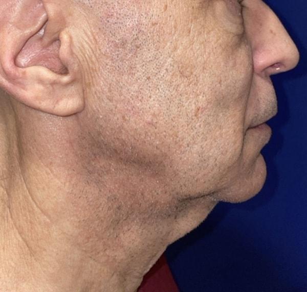 Facelift before at Idaho Eyelid & Facial Plastic Surgery in Boise, ID