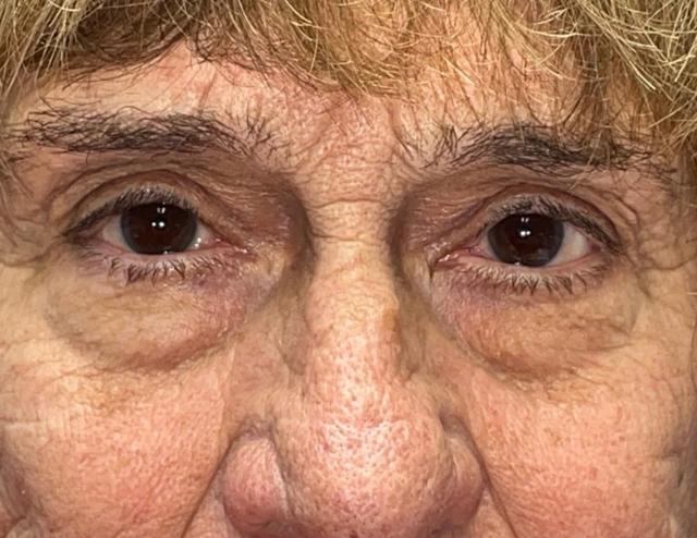 Blepharoplasty before at Idaho Eyelid & Facial Plastic Surgery in Boise, ID