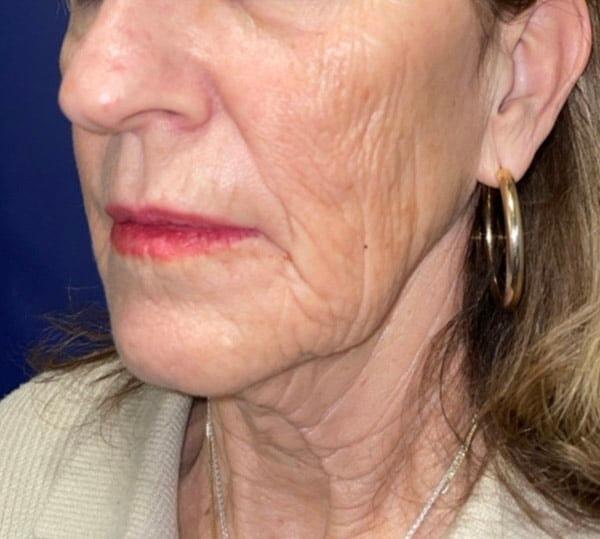 Morpheus8 before at Idaho Eyelid & Facial Plastic Surgery in Boise, ID