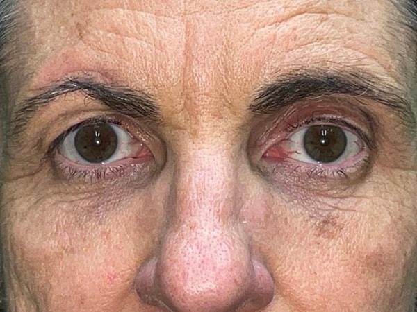 Brow Lift after at Idaho Eyelid & Facial Plastic Surgery in Boise, ID