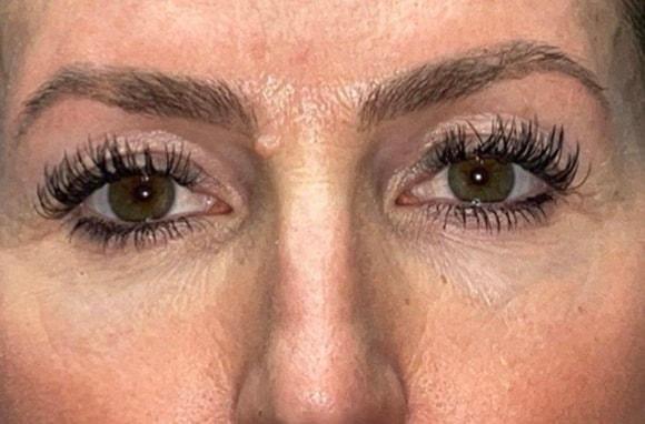 Blepharoplasty before at Idaho Eyelid & Facial Plastic Surgery in Boise, ID