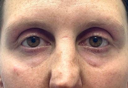 Blepharoplasty before at Idaho Eyelid & Facial Plastic Surgery in Boise, ID