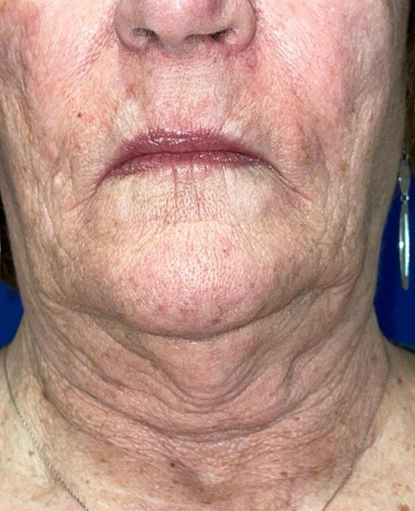 Facelift before at Idaho Eyelid & Facial Plastic Surgery in Boise, ID