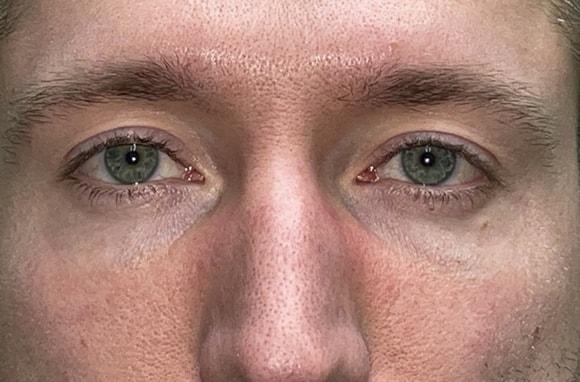 Blepharoplasty after at Idaho Eyelid & Facial Plastic Surgery in Boise, ID