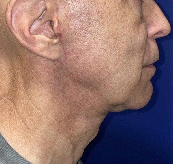 Facelift after at Idaho Eyelid & Facial Plastic Surgery in Boise, ID