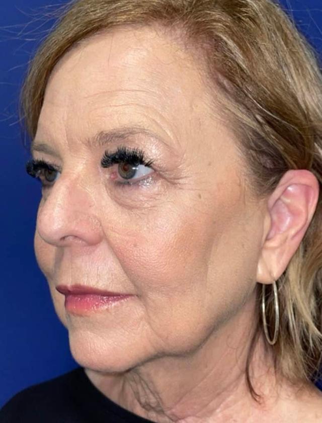 Facelift before at Idaho Eyelid & Facial Plastic Surgery in Boise, ID