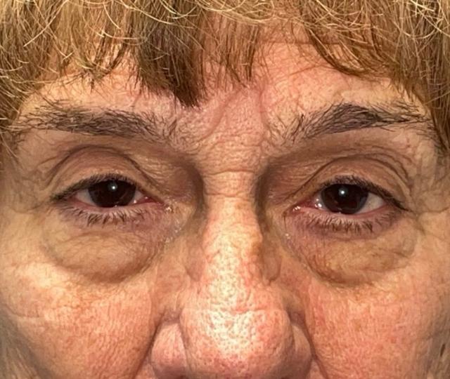 Blepharoplasty after at Idaho Eyelid & Facial Plastic Surgery in Boise, ID