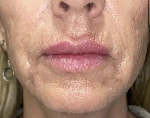 Morpheus8 before at Idaho Eyelid & Facial Plastic Surgery in Boise, ID