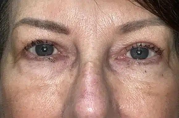 Blepharoplasty after at Idaho Eyelid & Facial Plastic Surgery in Boise, ID