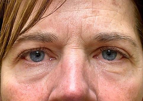 Brow Lift before at Idaho Eyelid & Facial Plastic Surgery in Boise, ID