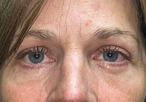 Brow Lift after at Idaho Eyelid & Facial Plastic Surgery in Boise, ID
