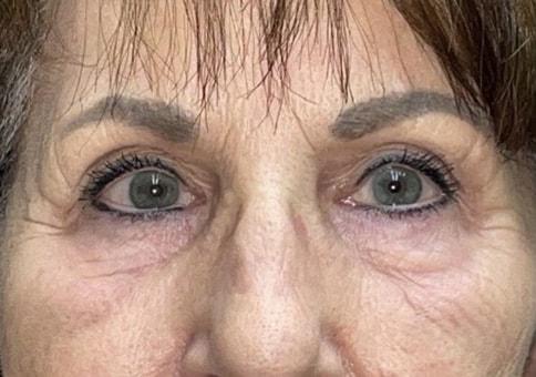 Brow Lift after at Idaho Eyelid & Facial Plastic Surgery in Boise, ID