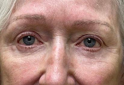 Blepharoplasty after at Idaho Eyelid & Facial Plastic Surgery in Boise, ID