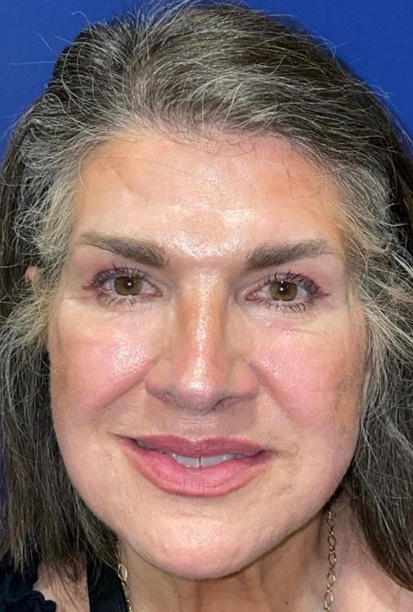 Laser Skin Resurfacing after at Idaho Eyelid & Facial Plastic Surgery in Boise, ID