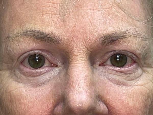 Brow Lift after at Idaho Eyelid & Facial Plastic Surgery in Boise, ID