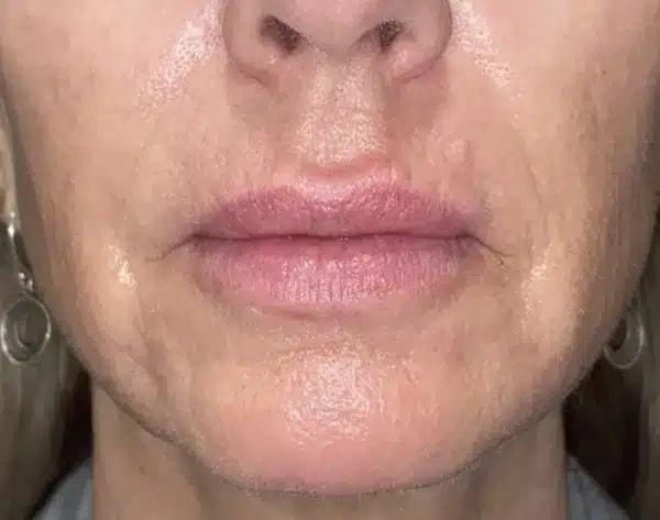 Morpheus8 after at Idaho Eyelid & Facial Plastic Surgery in Boise, ID