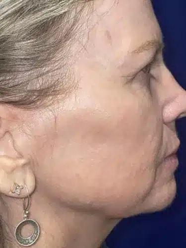 Morpheus8 after at Idaho Eyelid & Facial Plastic Surgery in Boise, ID