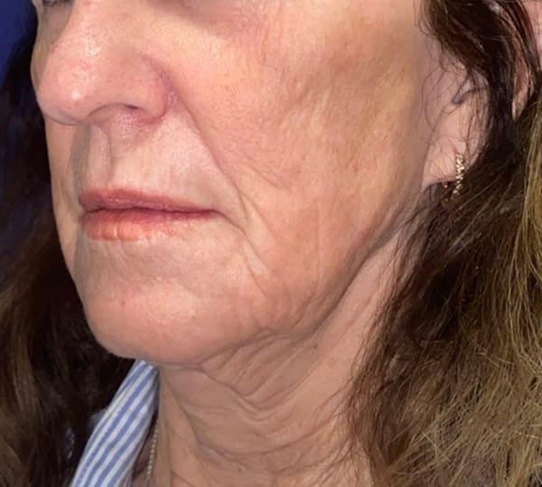 Morpheus8 after at Idaho Eyelid & Facial Plastic Surgery in Boise, ID