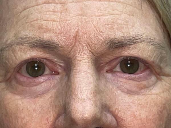 Brow Lift before at Idaho Eyelid & Facial Plastic Surgery in Boise, ID
