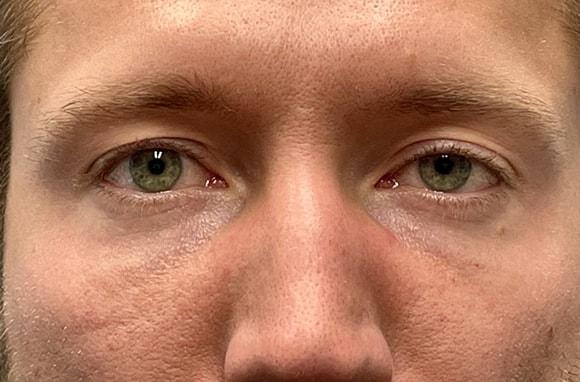 Blepharoplasty before at Idaho Eyelid & Facial Plastic Surgery in Boise, ID