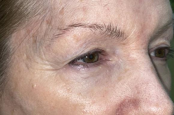 Blepharoplasty before at Idaho Eyelid & Facial Plastic Surgery in Boise, ID