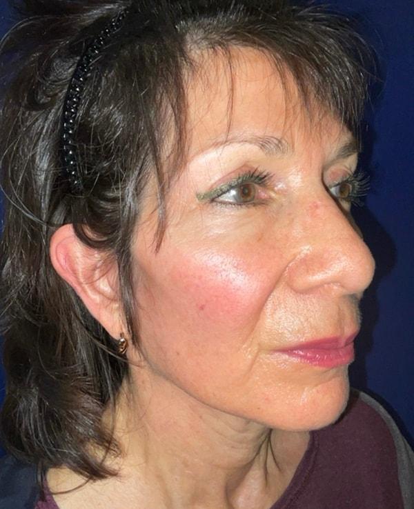 Facelift after at Idaho Eyelid & Facial Plastic Surgery in Boise, ID