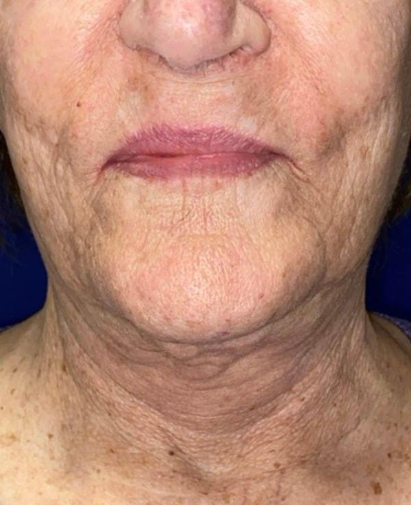 Facelift after at Idaho Eyelid & Facial Plastic Surgery in Boise, ID