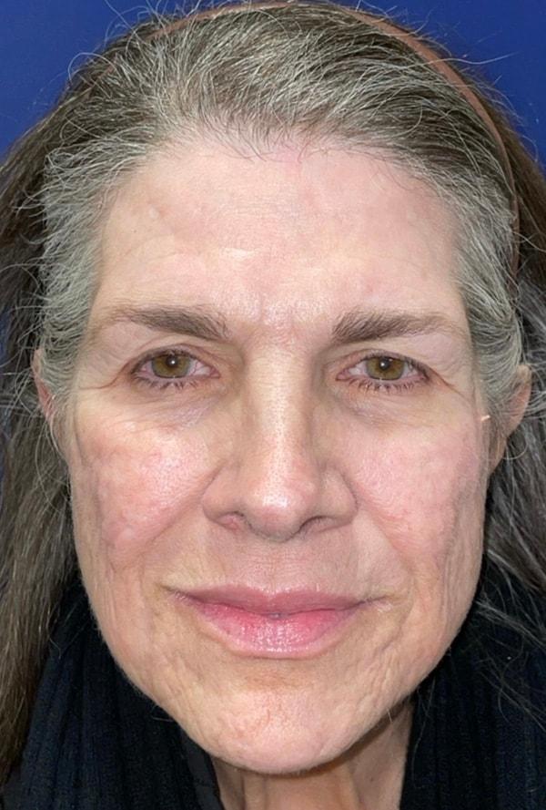 Laser Skin Resurfacing before at Idaho Eyelid & Facial Plastic Surgery in Boise, ID