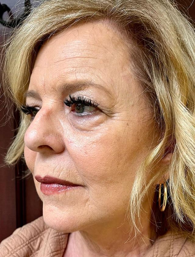 Facelift after at Idaho Eyelid & Facial Plastic Surgery in Boise, ID