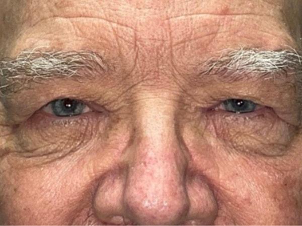 Brow Lift before at Idaho Eyelid & Facial Plastic Surgery in Boise, ID