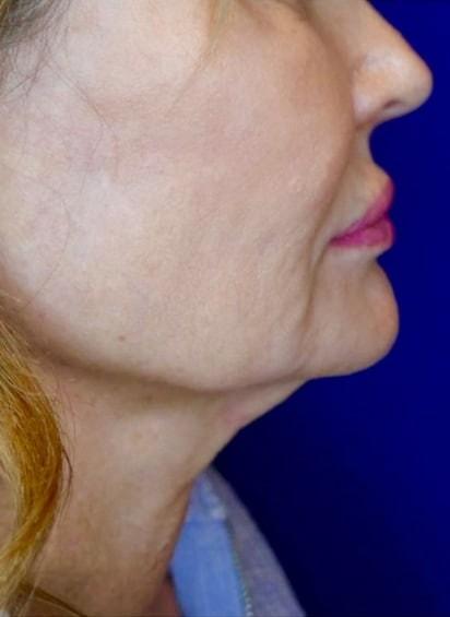 Facelift before at Idaho Eyelid & Facial Plastic Surgery in Boise, ID