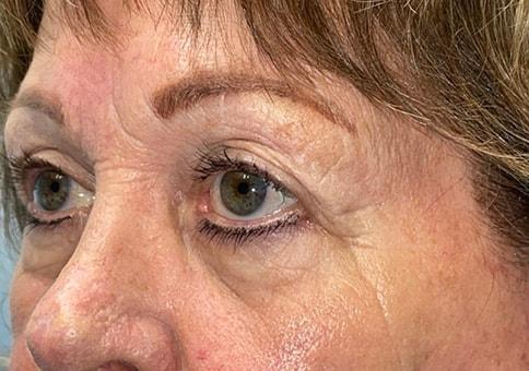Brow Lift after at Idaho Eyelid & Facial Plastic Surgery in Boise, ID