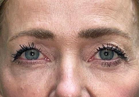 Brow Lift before at Idaho Eyelid & Facial Plastic Surgery in Boise, ID