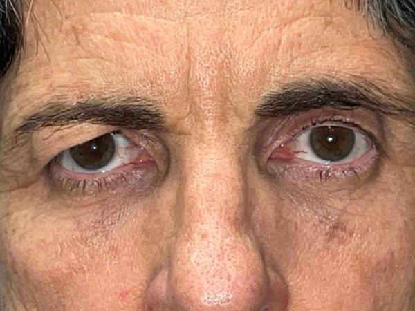 Brow Lift before at Idaho Eyelid & Facial Plastic Surgery in Boise, ID