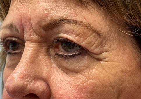 Brow Lift before at Idaho Eyelid & Facial Plastic Surgery in Boise, ID