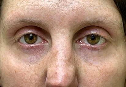Blepharoplasty after at Idaho Eyelid & Facial Plastic Surgery in Boise, ID