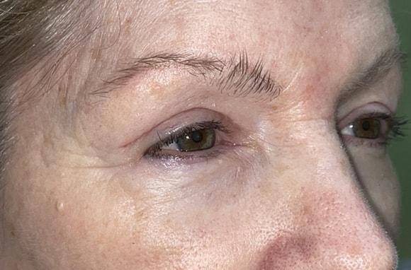 Blepharoplasty after at Idaho Eyelid & Facial Plastic Surgery in Boise, ID