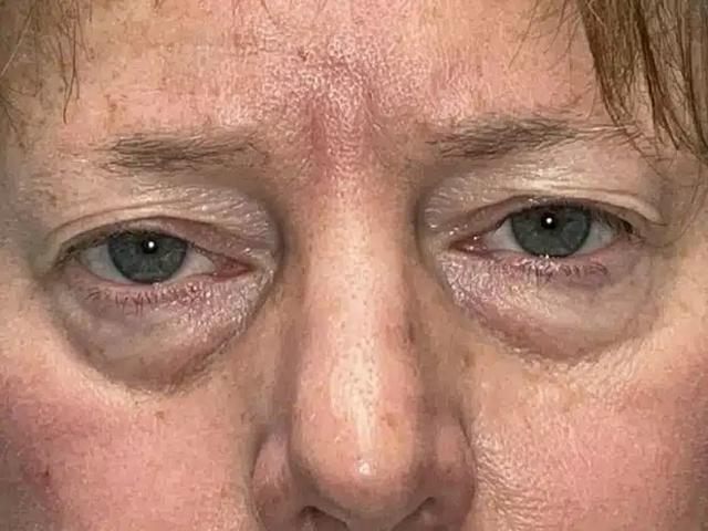 Brazilian Butt Lift before at Idaho Eyelid & Facial Plastic Surgery in Boise, ID