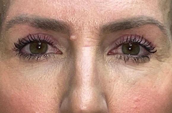 Blepharoplasty after at Idaho Eyelid & Facial Plastic Surgery in Boise, ID
