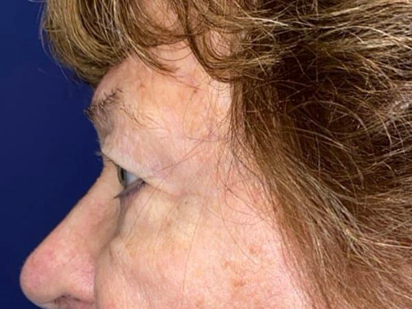 Brow Lift after at Idaho Eyelid & Facial Plastic Surgery in Boise, ID