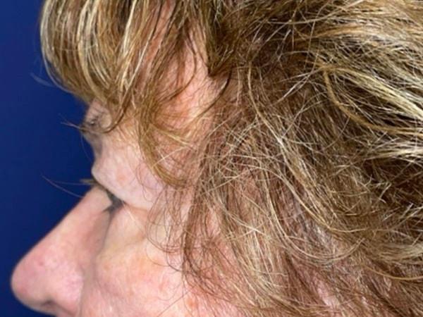 Brow Lift before at Idaho Eyelid & Facial Plastic Surgery in Boise, ID