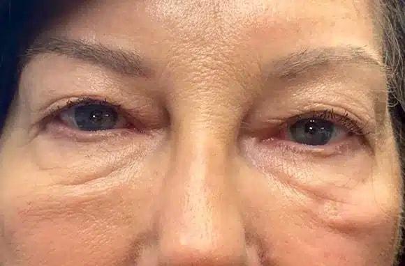 Blepharoplasty before at Idaho Eyelid & Facial Plastic Surgery in Boise, ID