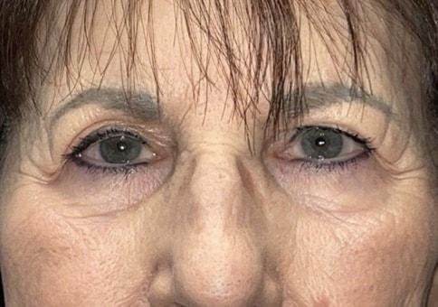Brow Lift before at Idaho Eyelid & Facial Plastic Surgery in Boise, ID