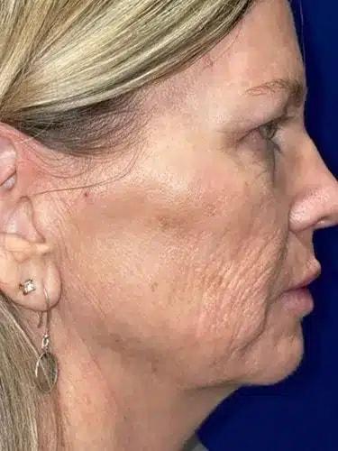 Morpheus8 before at Idaho Eyelid & Facial Plastic Surgery in Boise, ID