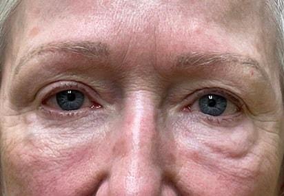 Blepharoplasty before at Idaho Eyelid & Facial Plastic Surgery in Boise, ID