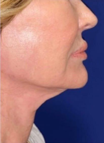Facelift after at Idaho Eyelid & Facial Plastic Surgery in Boise, ID