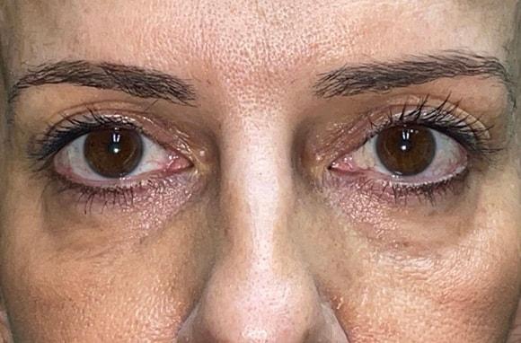 Blepharoplasty before at Idaho Eyelid & Facial Plastic Surgery in Boise, ID