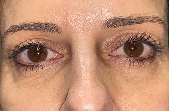 Blepharoplasty after at Idaho Eyelid & Facial Plastic Surgery in Boise, ID