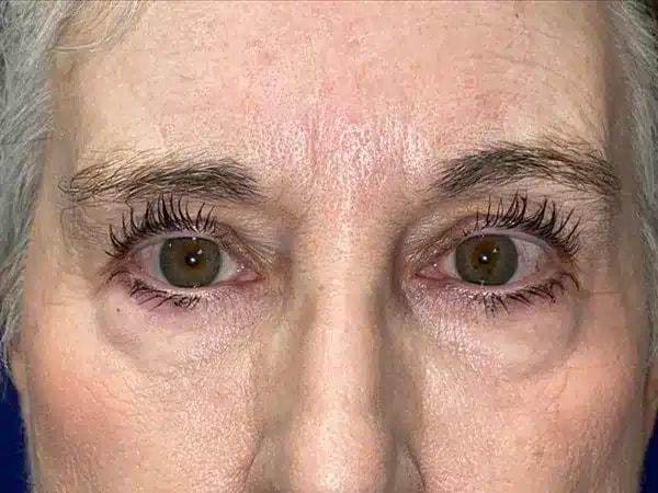 Brow Lift before at Idaho Eyelid & Facial Plastic Surgery in Boise, ID