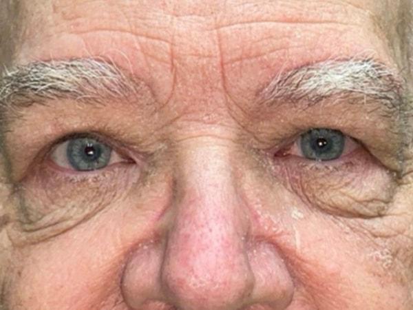 Idaho Eyelid & Facial Plastic Surgery brow lift after — Boise, ID